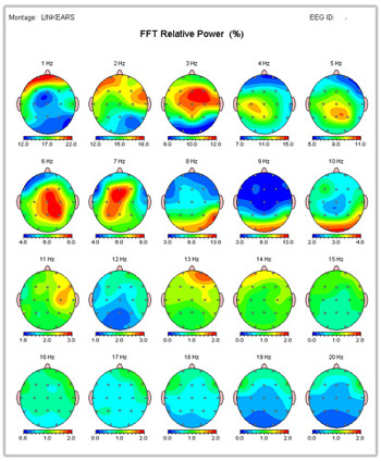 What can a QEEG Brain Map tell you?